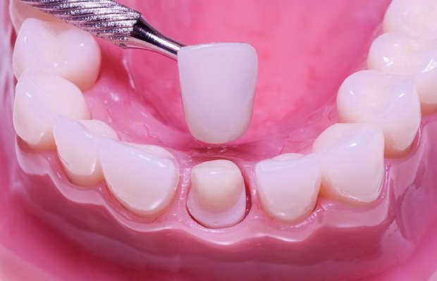 Quá trình bọc răng sứ diễn ra như thế nào?